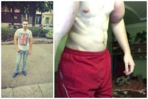 before and after synthol