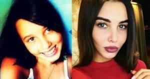 What kind of plastic surgery did Anastasia Reshetova, Timati’s girlfriend: photos before and after plastic surgery