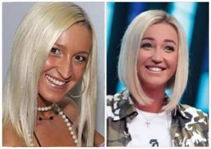 Ольга Бузова - фото до и после пластики носа, губ, скул. Как похудела, какие пластические операции делала