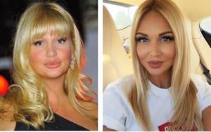 Vika Lopyreva “corrected” chubby cheeks by removing Bisha’s lumps