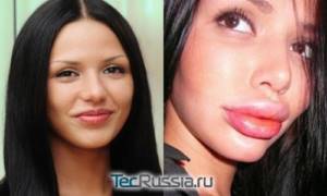 Светлана Давыдова из Дома-2 – фото до и после пластических операций