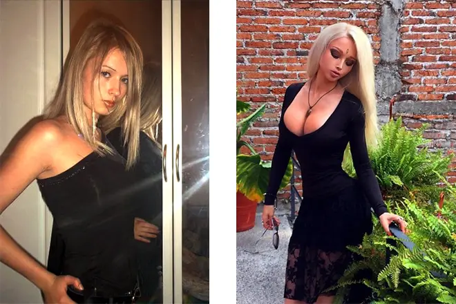 Valeria Lukyanova before and after surgery