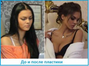 Vika Odintsova before and after plastic surgery